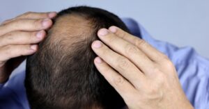 סובלים משיער דליל ונשירה_ הכירו את הפתרונות הכי יעילים